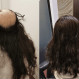Hair Replacement Singapore
